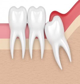 دندان های عقل و پری کرونیت